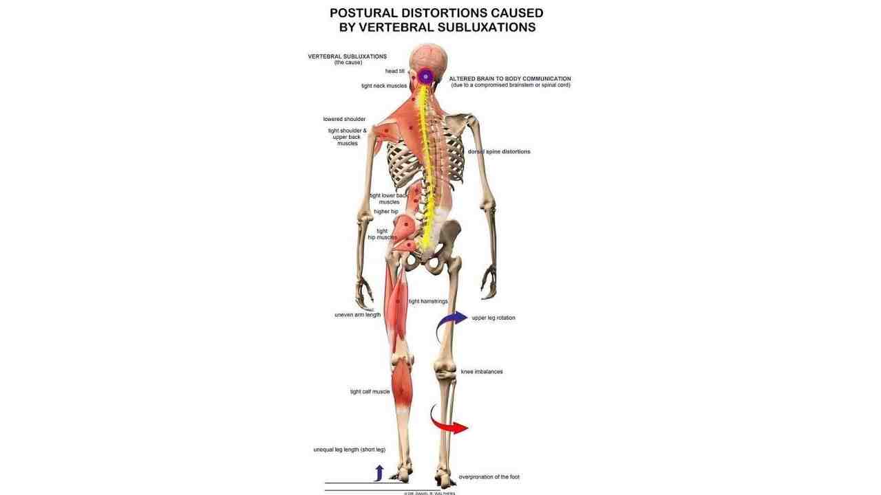 Common Postural Distortion Patterns